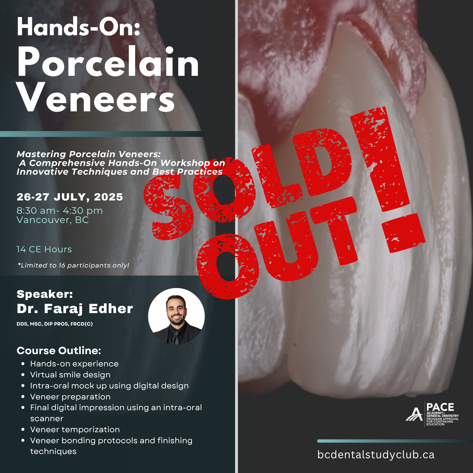 Porcelain Veneers Hands-on